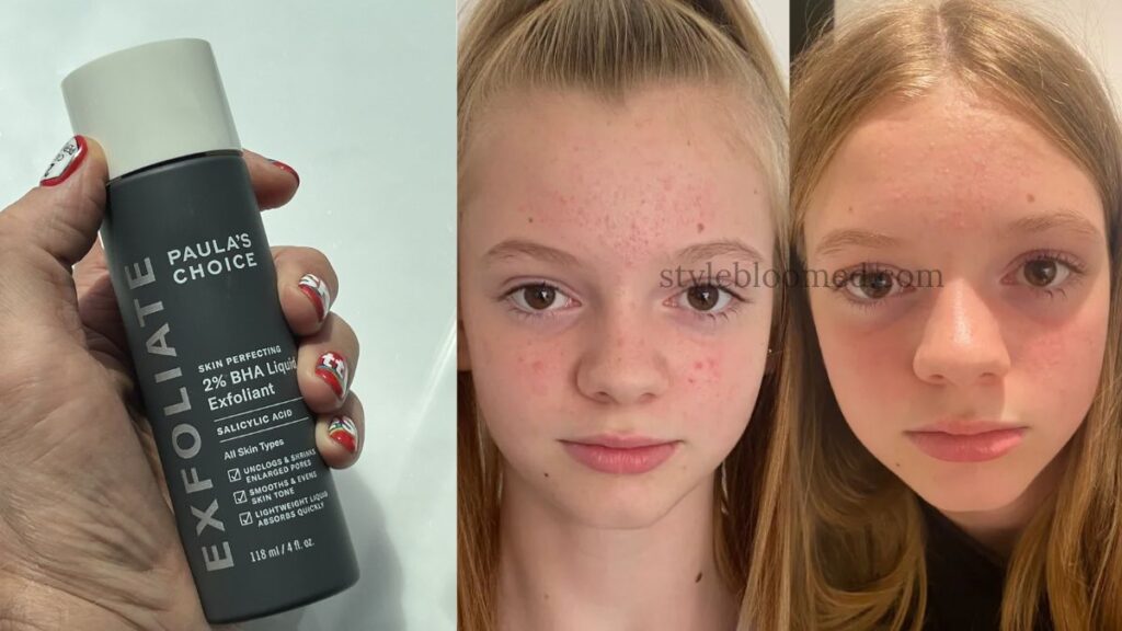 Easy 5 skincare routine for oily & acne-prone skin